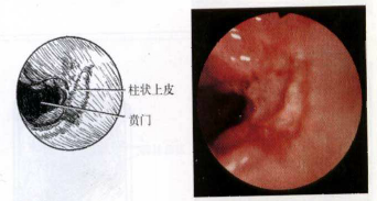 齿状线上2cm酷似胃粘膜,病灶区可见充血,水肿,糜烂,溃疡